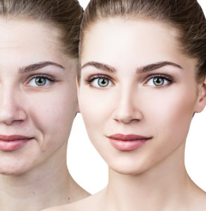 Wrinkle Reduction and Skin Rejuvenation with Venus Viva and Venus Swan