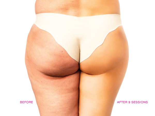 the-body-firm-cellulite-treatment-in-singapore