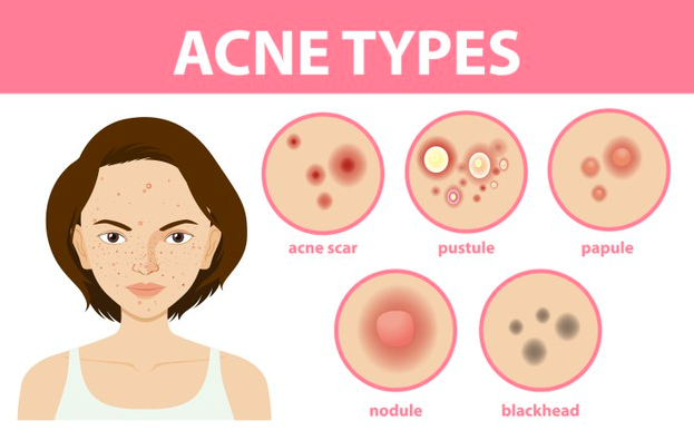 The Body Firm | Treat Acne Scars For Good