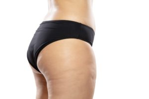 The Body Firm | 8 Natural Remedies for Cellulite