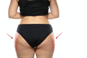 The Body Firm | How To Lose Those Saddlebags Fat?