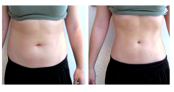 Before and after photos of The Body Firm's body contouring method